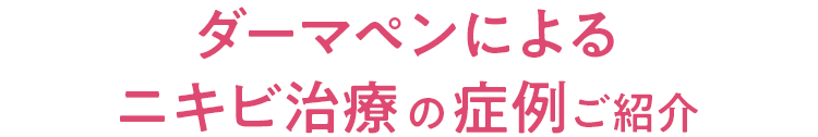 ダーマペンによるニキビ治療の症例ご紹介